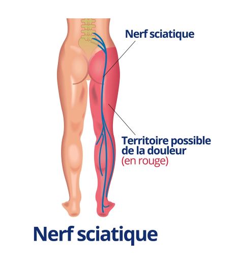 La Sciatalgie ! - Physiothérapie St-François